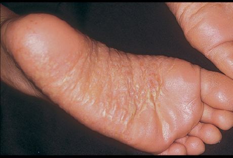 Dermatitis af ben og dens årsager