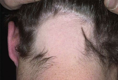 Alopecia areata