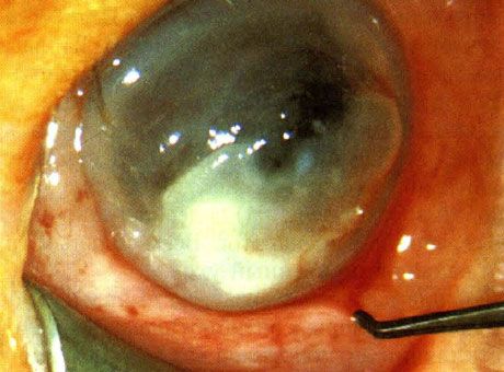 Keratitis forårsaget af Pseudomonas hos en nyfødt.  Predisponerende faktorer er ikke identificeret