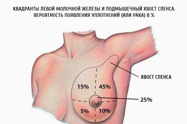 Kvadranterne i venstre bryst og spindelens aksillære spence.  Sandsynligheden for sæler (eller kræft) i%