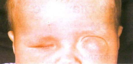 Microphthalmus med samtidig cystedannelse (venstre øje).  Anophthalmus (højre øje).
