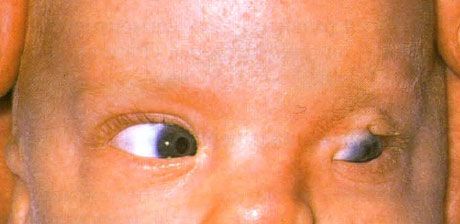 Fraser Syndrome.  Ufuldstændige kryptophthalmos i venstre øje.