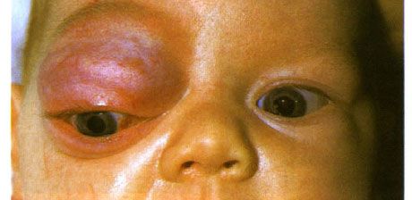 Kapillær hemangiom i den forreste del af bane og øvre øjenlåg.  Neoplasma har tendens til at udvikle sig