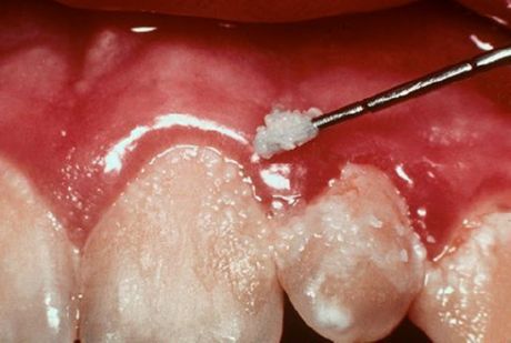 Tænder og tandhindebetændelse