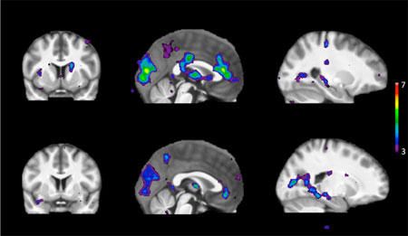 Scanning viser områder af hjerneaktivitet som reaktion på stimuli hos mennesker med en hurtig metabolisme af nikotin (øverste række) og en langsom metabolisme af nikotin (nederste række)