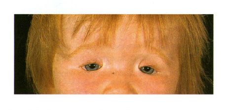 Tosidet colobom af øjenlågene i et barn med Goldens syndrom.  Lukning af øjets spalt til venstre