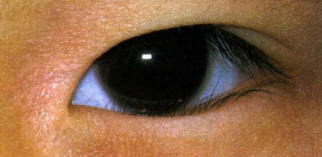 Epiblefaron.  Forkert vækst af øjenvipper fejres fra fødslen.  Nogle gange er der en spontan forbedring