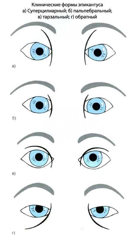 Kliniske former for epicanthus.  a) Superciliary, b) palpebral, c) tarsal, d) revers